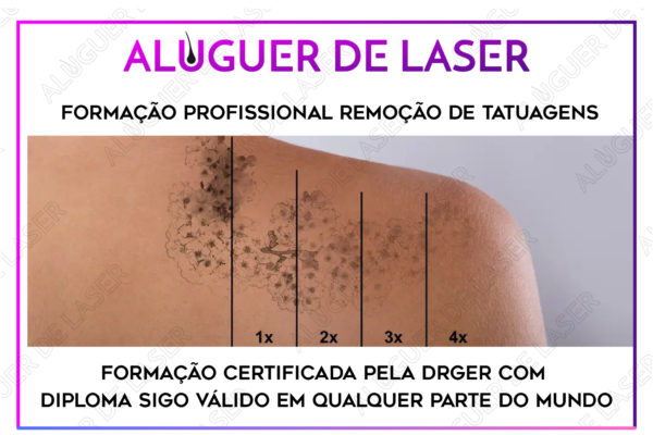 Formação profissional  </br> remoção de tatuagens